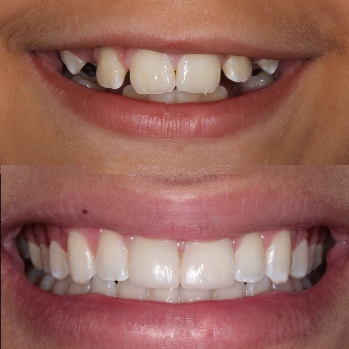 Antes e depois de tratamento odontopediátrico