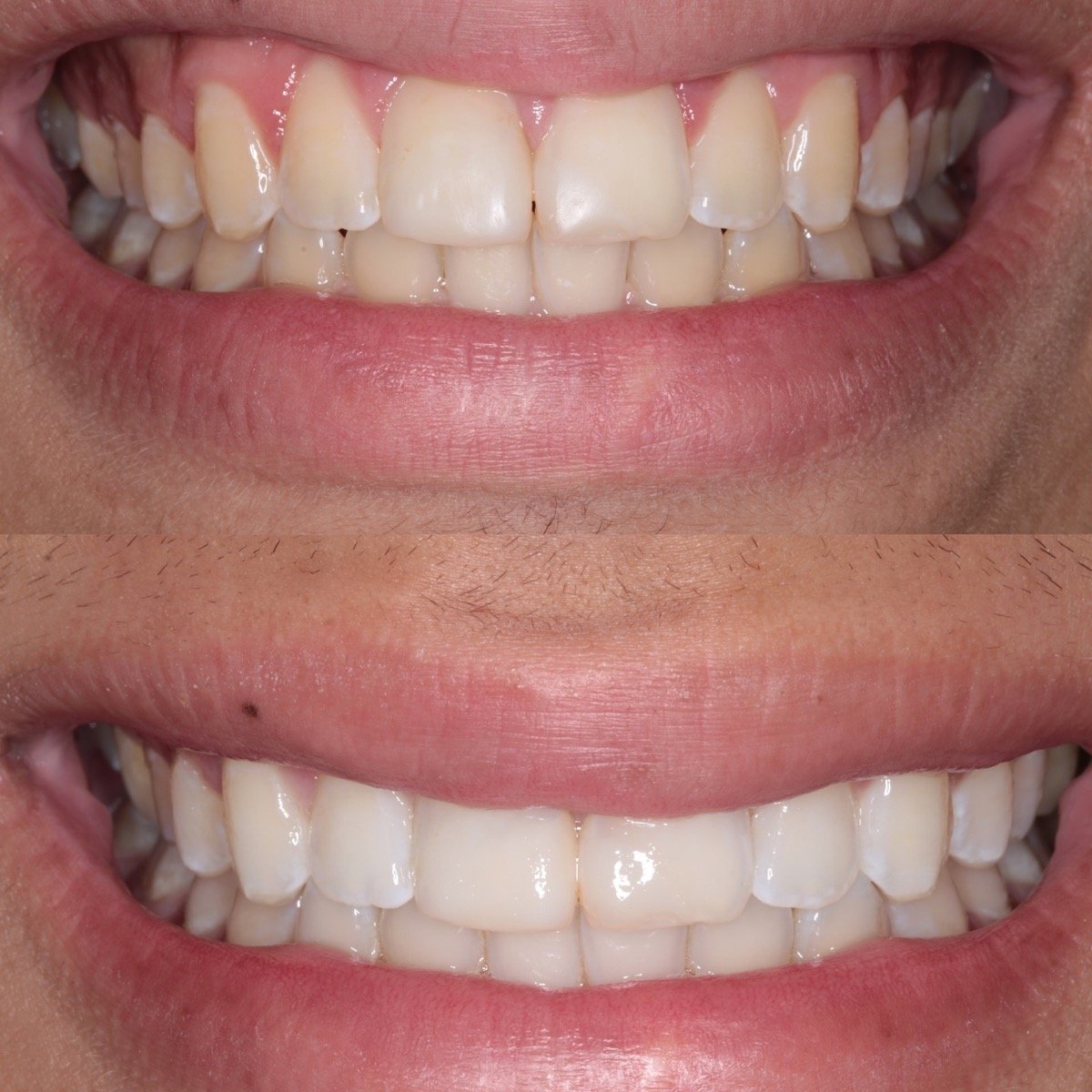 Antes e depois de tratamento estético