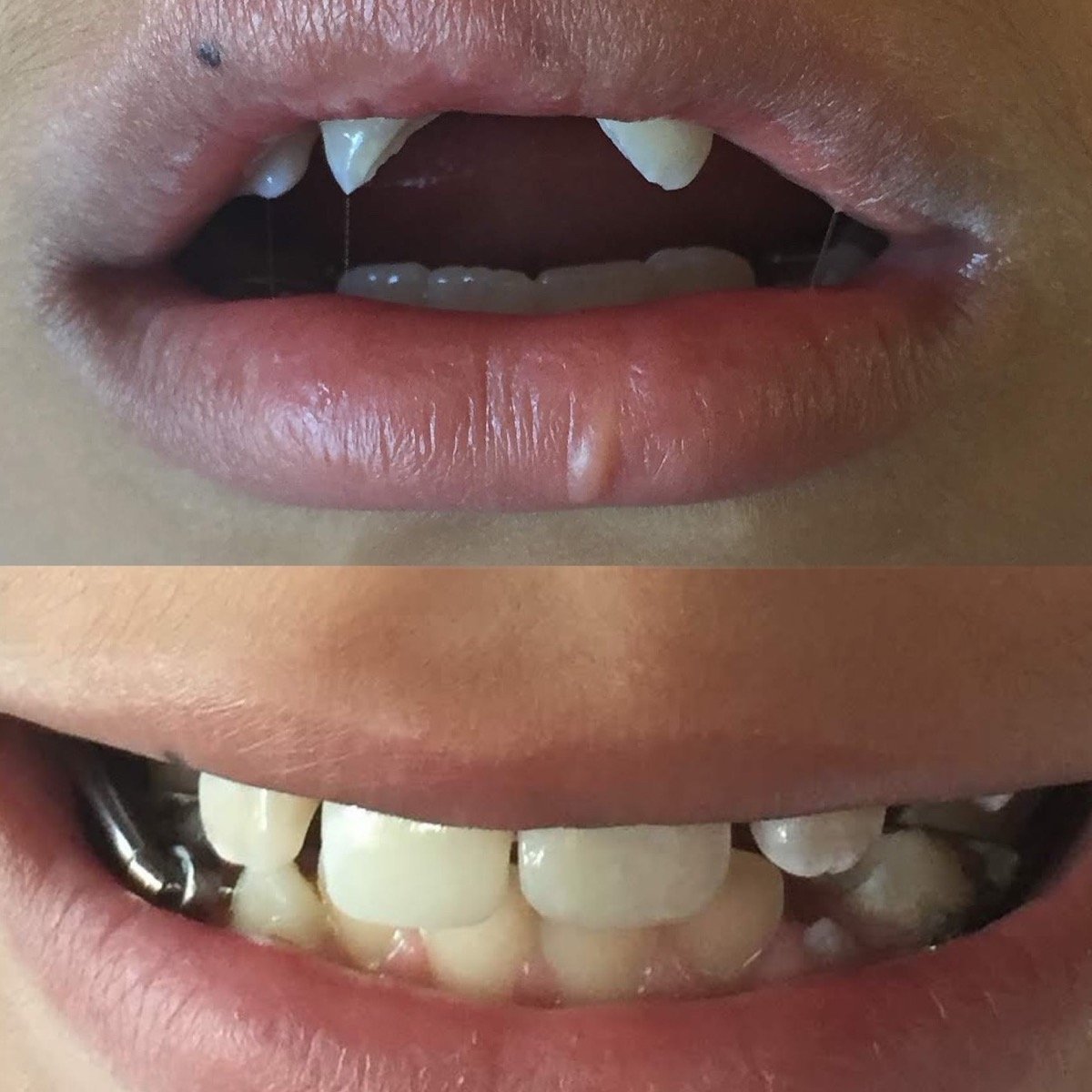 Antes e depois de reabilitação dentária