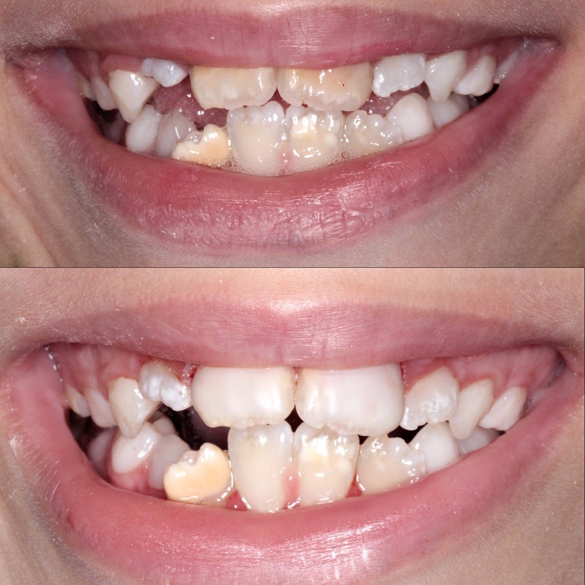Antes e depois de tratamento em criança